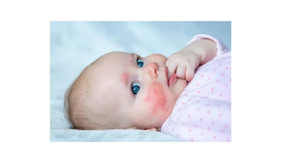 Understanding Baby Acne